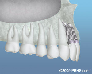 Bone Grafting