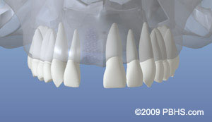 Dental Implants treatment NY