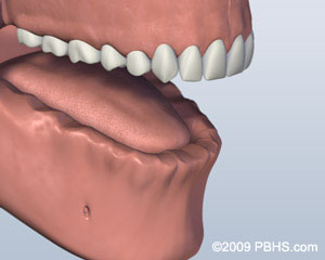 Missingallow upper teeth