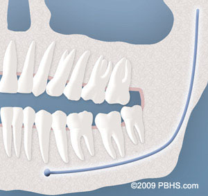 wisdom tooth soft tissue impaction