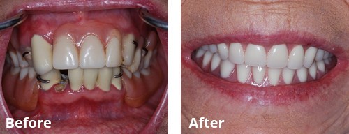 dental implant
