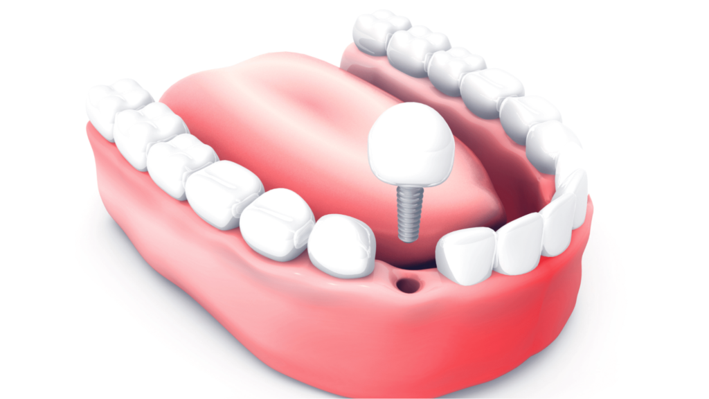 All about dental implants - Are they right for you?